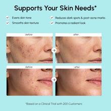 Load image into Gallery viewer, Azelaic Acid Cream for Sensitive Skin